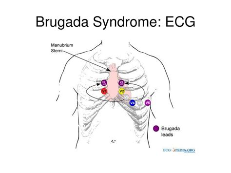 Brugada Syndrome as a Major Cause of Sudden Cardiac Death .